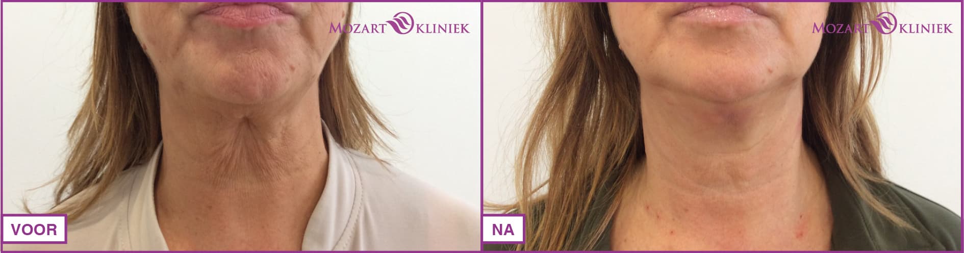 Voor en na foto van een halslift zonder operatie met een Lipodefine behandeling - Mozart Kliniek